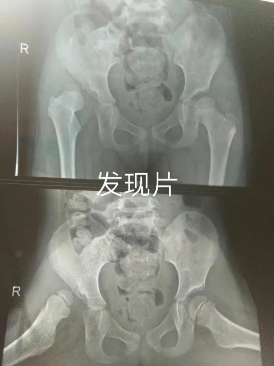 骨盆三联截骨术后X光片
